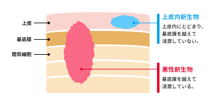 上皮内新生物の構造図