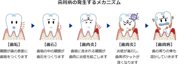 歯周病の発生するメカニズム