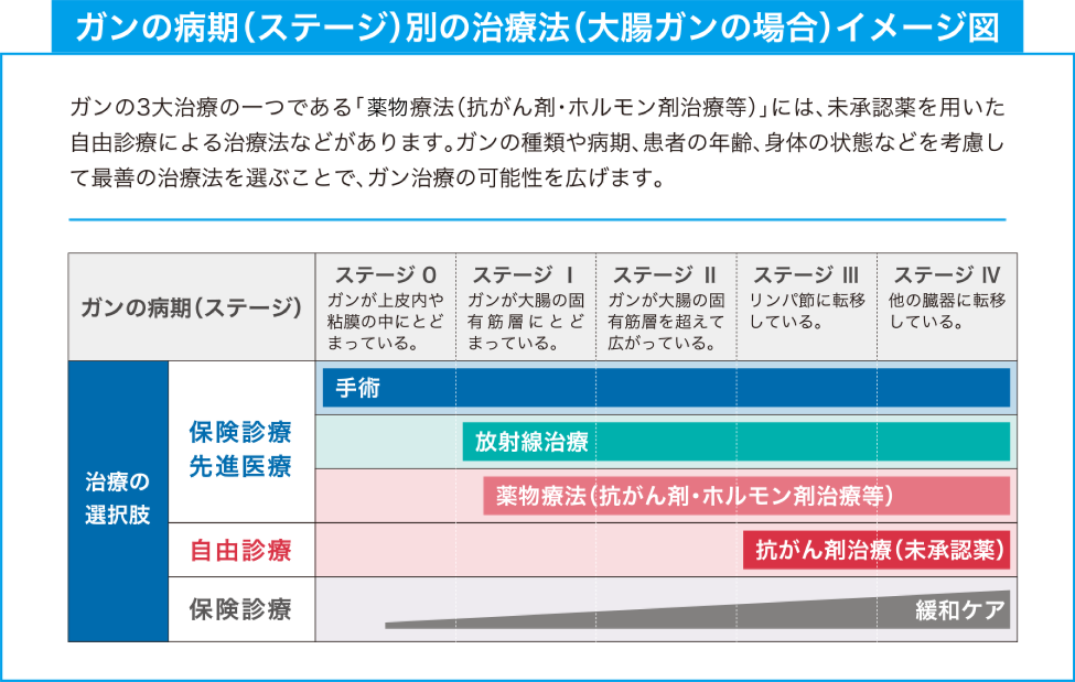 ガンの病期（ステージ）別の治療法（大腸ガンの場合）イメージ図