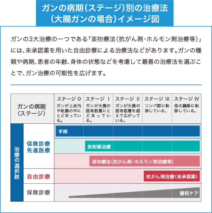 ガンの病期（ステージ）別の治療法（大腸ガンの場合）イメージ図