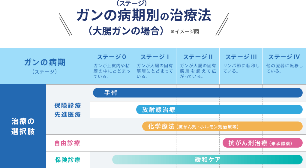 ガンの病期別（ステージ）の治療法（大腸ガンの場合）※イメージ図